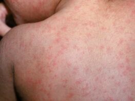 Measles outbreak: More than 8,000 cases registered in Kyrgyzstan