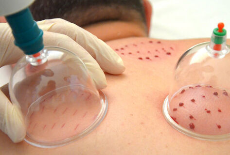 Хиджама для младенца: как вера в&nbsp;&laquo;народное лечение&raquo; привела к&nbsp;трагедии в&nbsp;Узгене
