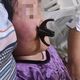 Фото Министерства здравоохранения. Девочка упала лицом на ножницы