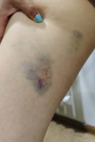 Фото адвоката Эсении Рамазановой. Гематомы на теле жертвы ала-качуу